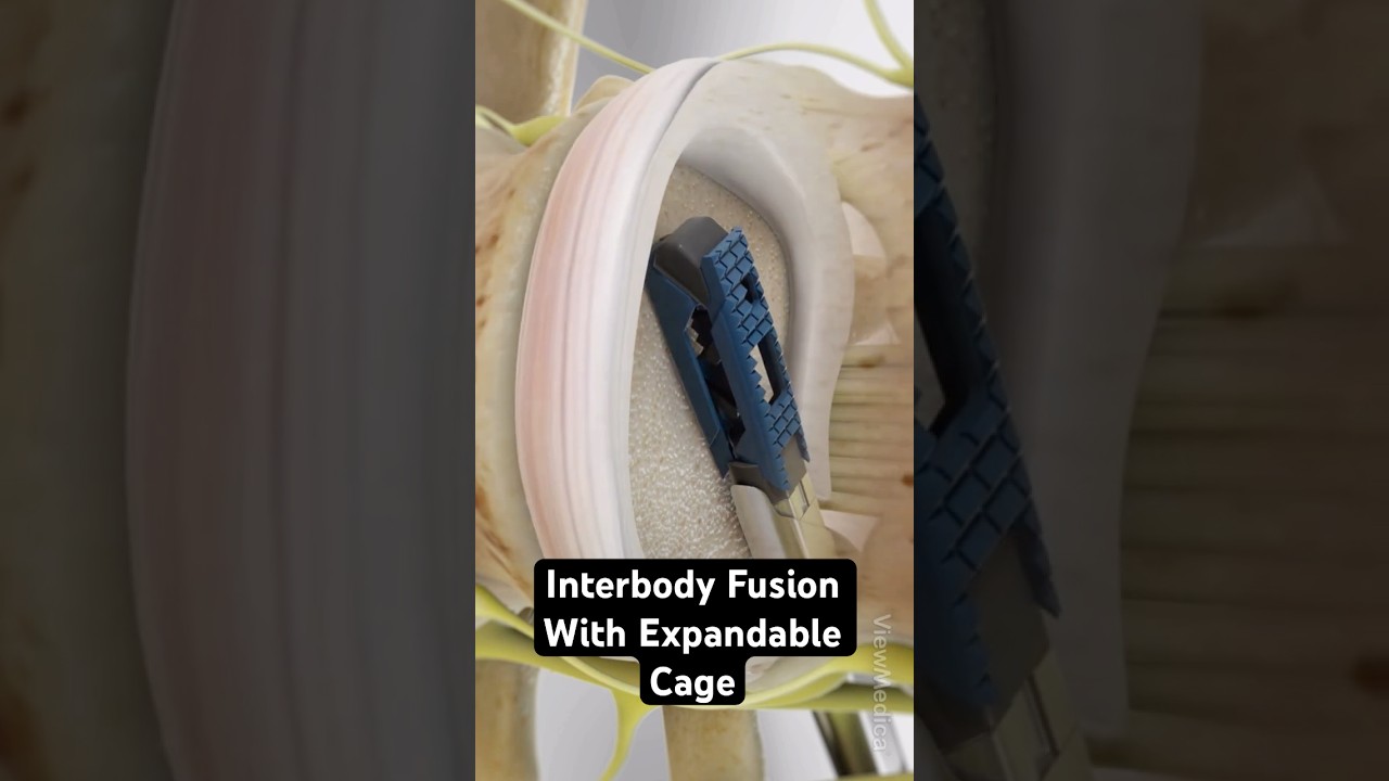 Lifting your spine with an expandable cage (3D Animation)