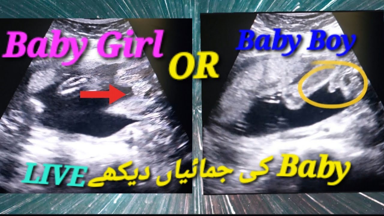 Fundoanterior Placenta Baby Gender | Genderreveal Ultrasound | BabyBoy/Girl | Fetal Yawning In Womb