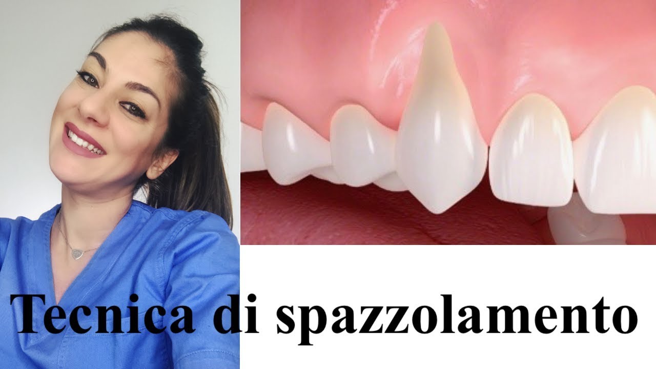 Tecnica di spazzolamento in presenza di retrazioni gengivali