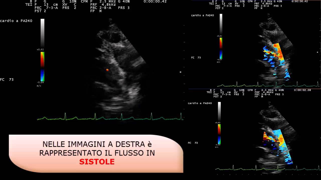 DOTTO DI BOTALLO PERVIO