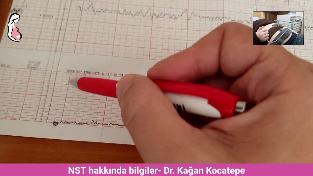 NST nasıl yorumlanır? Doğum sancısı-yalancı Braxton-Hicks rahim kasılmaları ve bebek kalp atışları