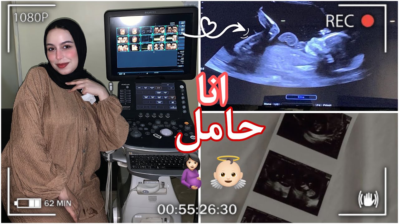 انا حامل🤰🏻ليه كنت مخبية؟ طلع عندي ورم علي الرحم ، الحمدلله♥️