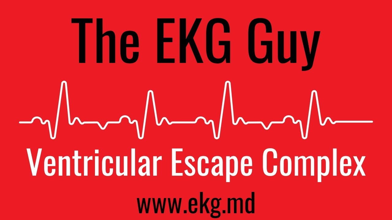 Ventricular Escape Complex EKG l The EKG Guy - www.ekg.md