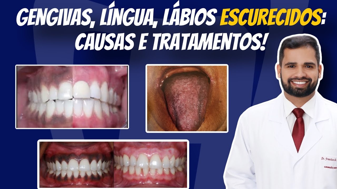 GENGIVAS ESCURECIDAS: LÍNGUA escurecida! Causas e tratamentos. #gengiva #peeling #quimioterapia