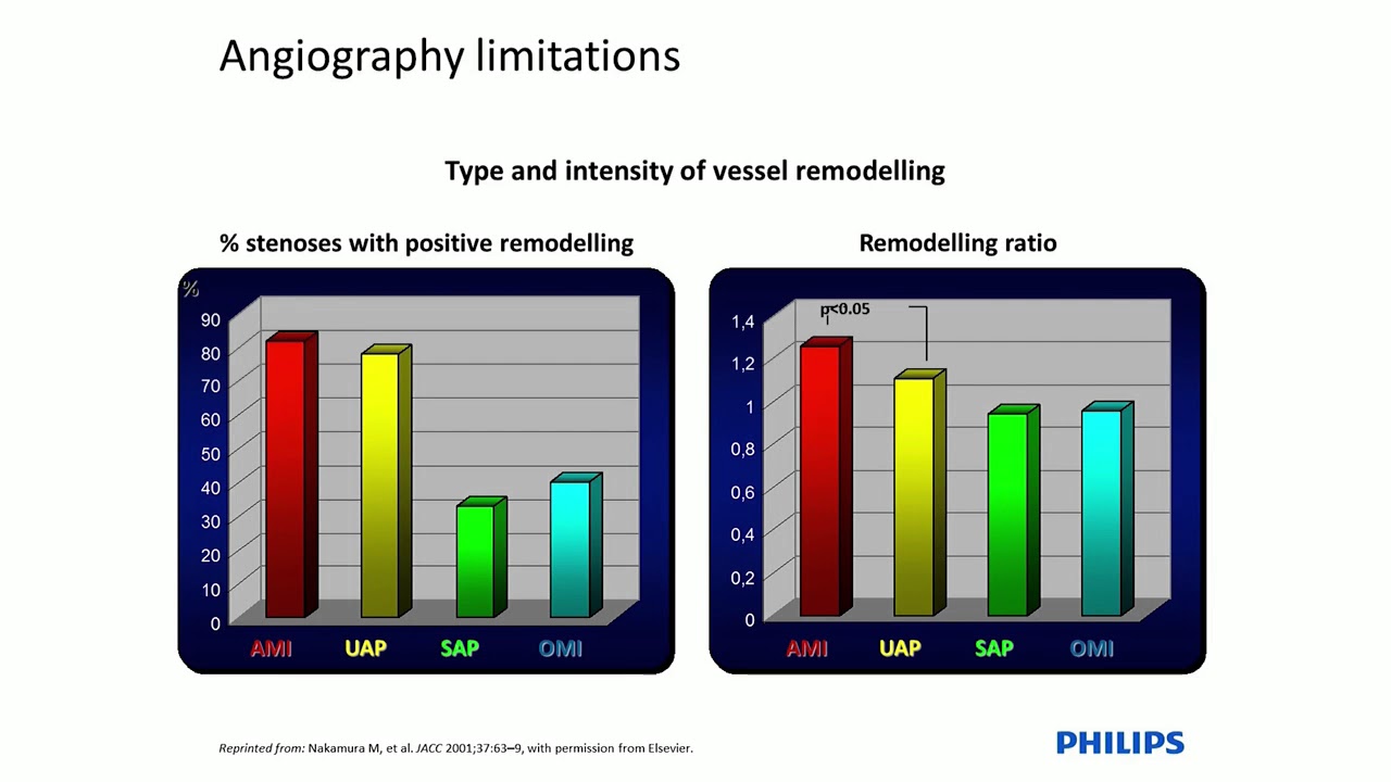 Use of IVUS Imaging in PCI on Left Main Coronary Artery Disease - Prof. Adrian Banning