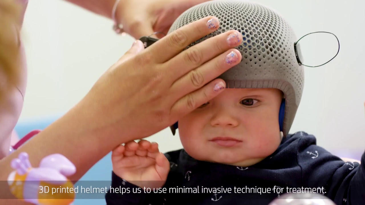 Helmets for Craniosynostosis Treatment  Jet Fusion 3D Printer  HP