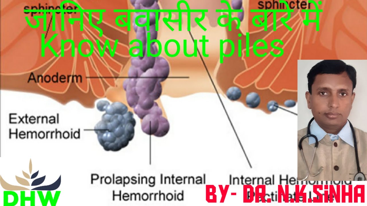 piles (babasir)