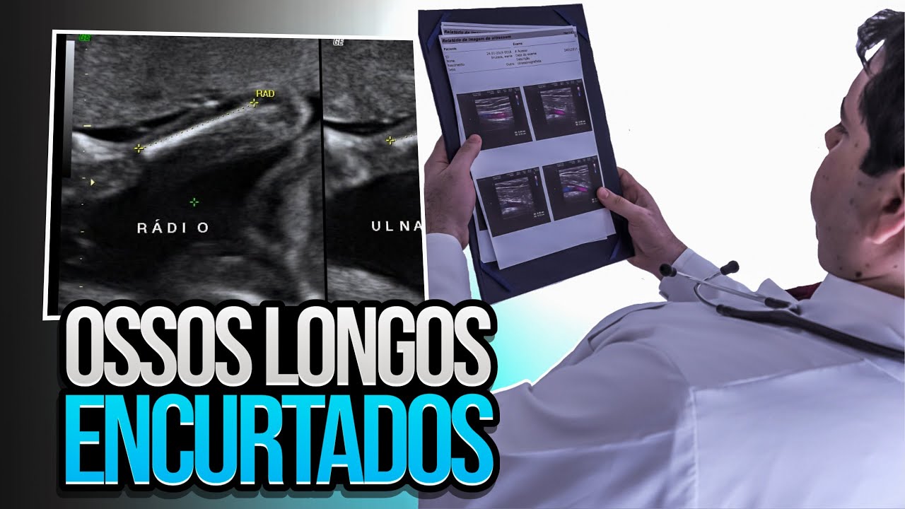 Ultrassom Morfológico Alterado - Ossos Longos Encurtados