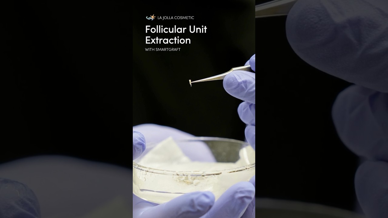 Precision in Action: Up Close with Follicular Unit Extraction (FUE)