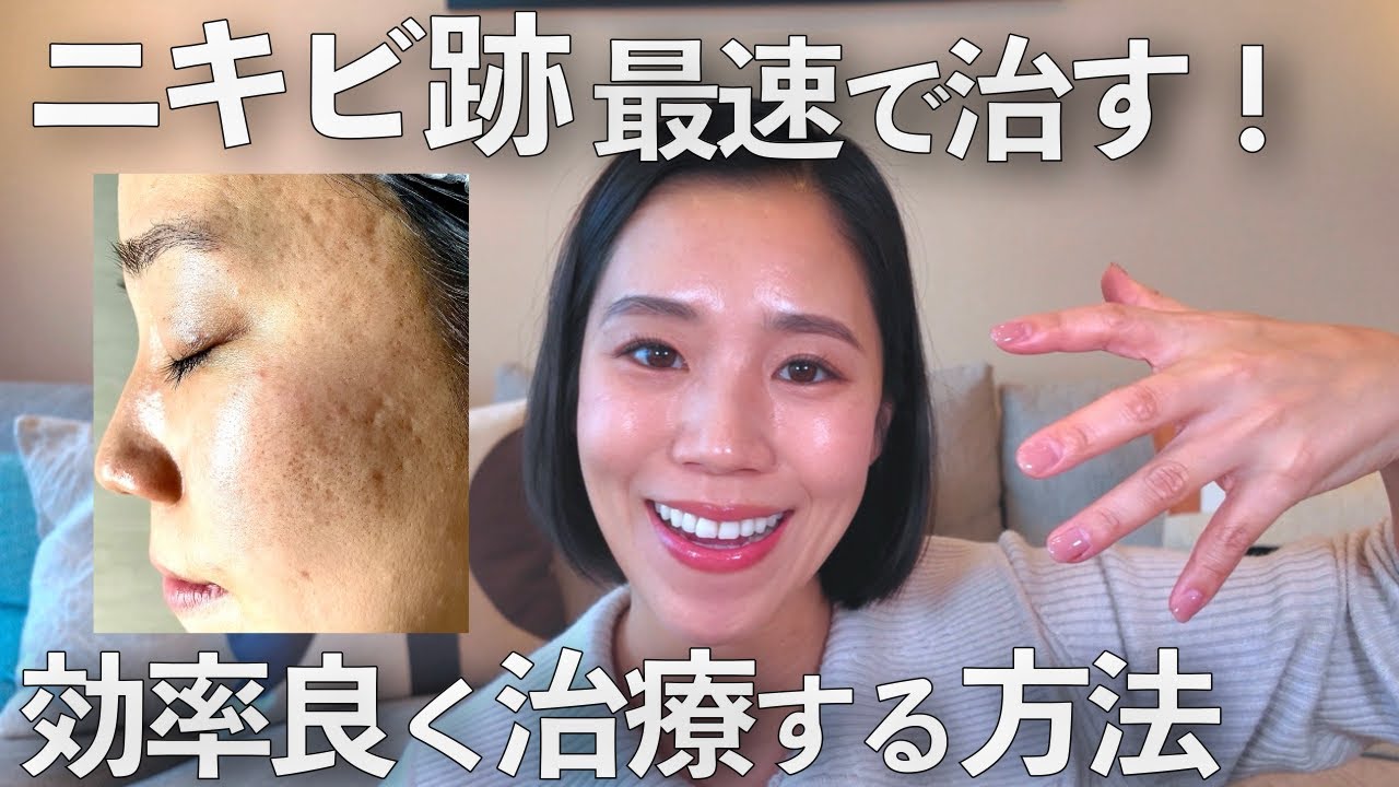 治療費100万以上かけて分かった！効率よくクレーター跡を治療する方法