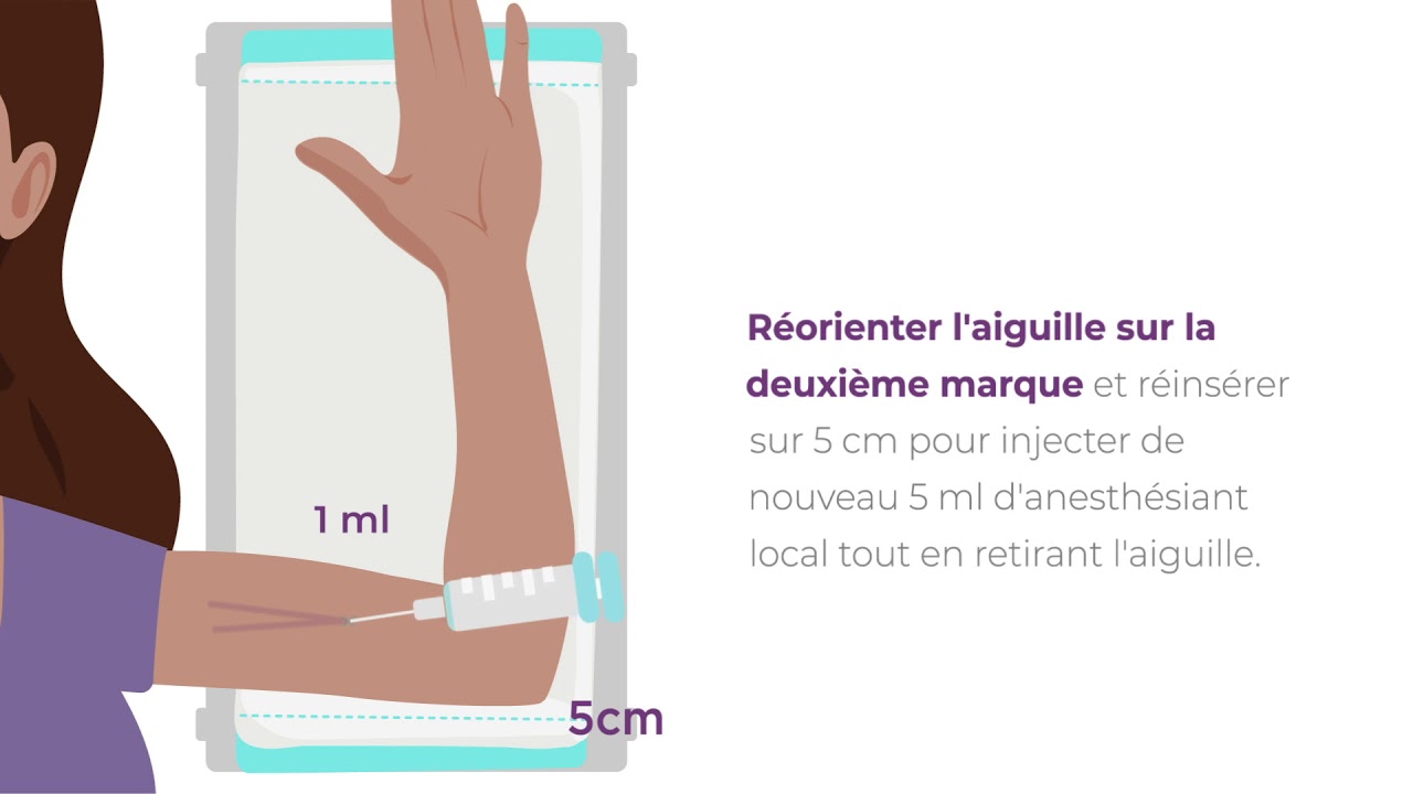 Comment insérer les implants Levoplant™ ?  [ANCIENNE VERSION] Version mise à jour disponible !