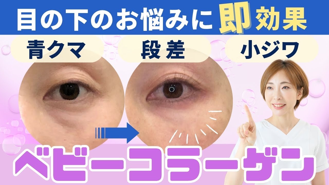 切らずに即若返り！目の下の青クマ・小ジワにベビーコラーゲンが即効アプローチ