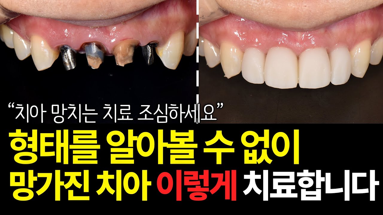 치아 망치는 “이거” 제발 하지마세요 (앞니 브릿지 2편)