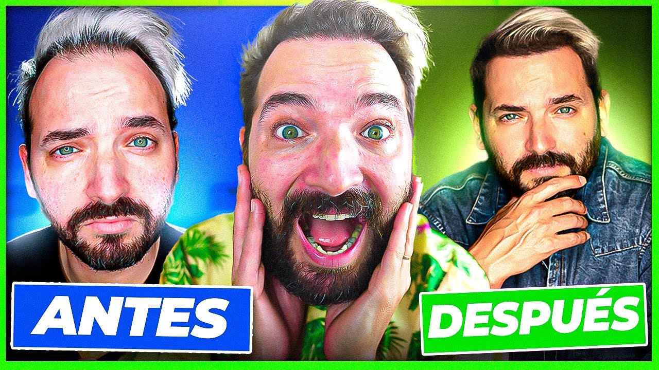 TRANSPLANTE de CABELLO - 6 MESES DESPUÉS (FOTOS DE ANTES Y DESPUES)