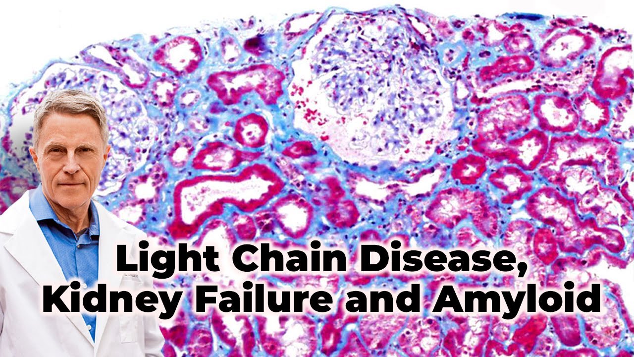 Light Chain Disease, Kidney Failure and Amyloid -FORD BREWER MD MPH