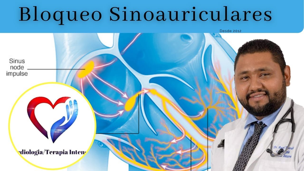Bloqueos sinoatriales: Todo lo que necesitas saber