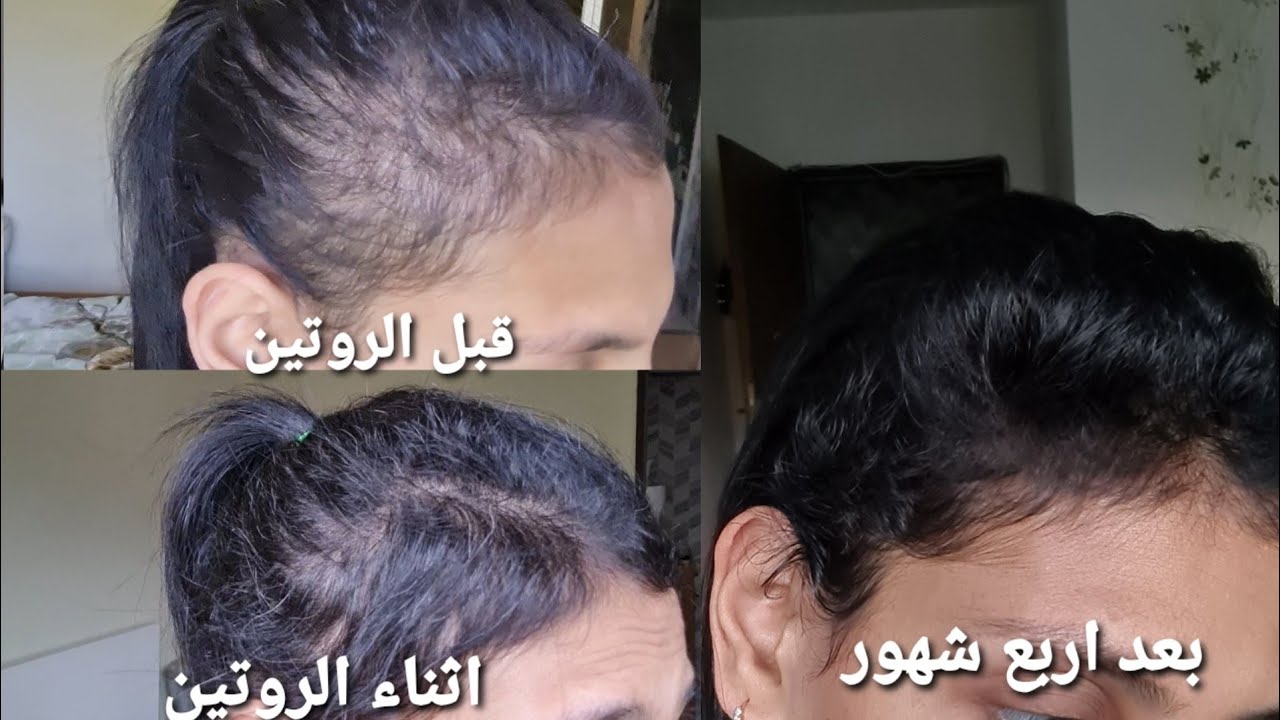 تجربتى مع انبات الشعر