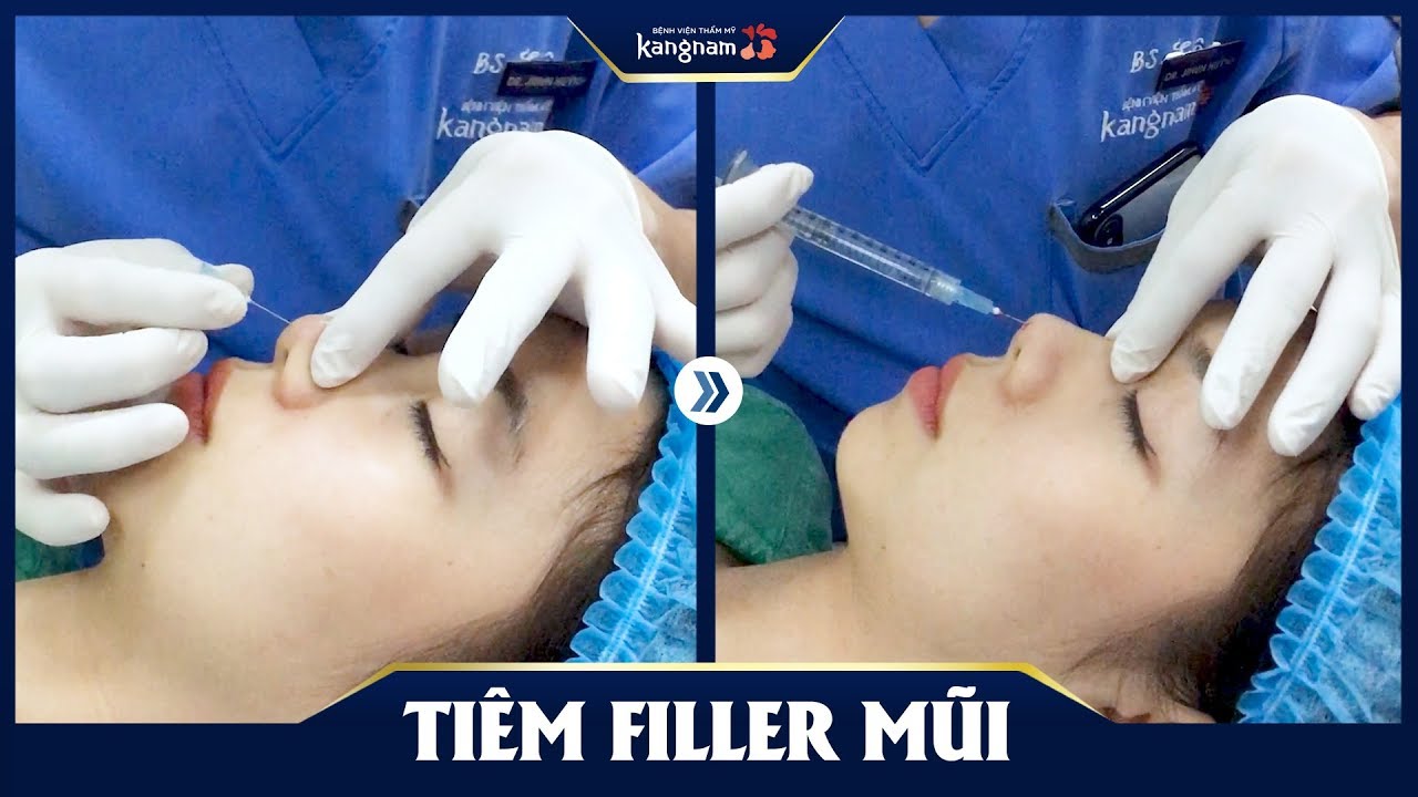 Tiêm filler mũi: Phương pháp nâng mũi không cần phẫu thuật