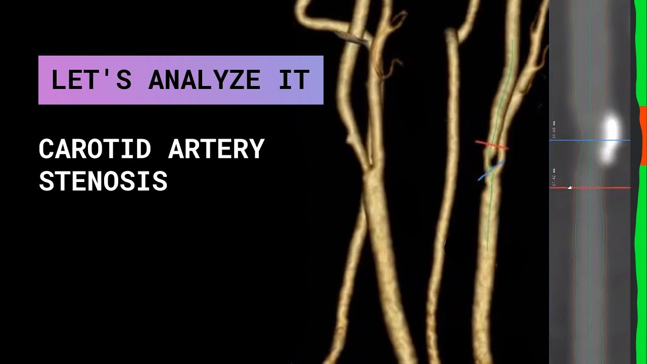 Let's analyze it. Сarotid artery stenosis