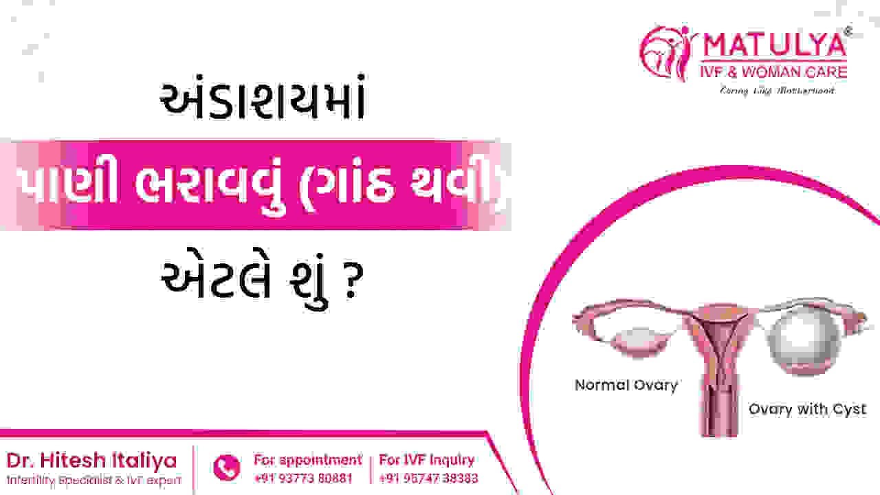 અંડાશયમાં પાણી ભરાવવું (ગાંઠ થવી) એટલે શું ?|Matulya IVF & Woman care|Dr.Hitesh italiya| Surat