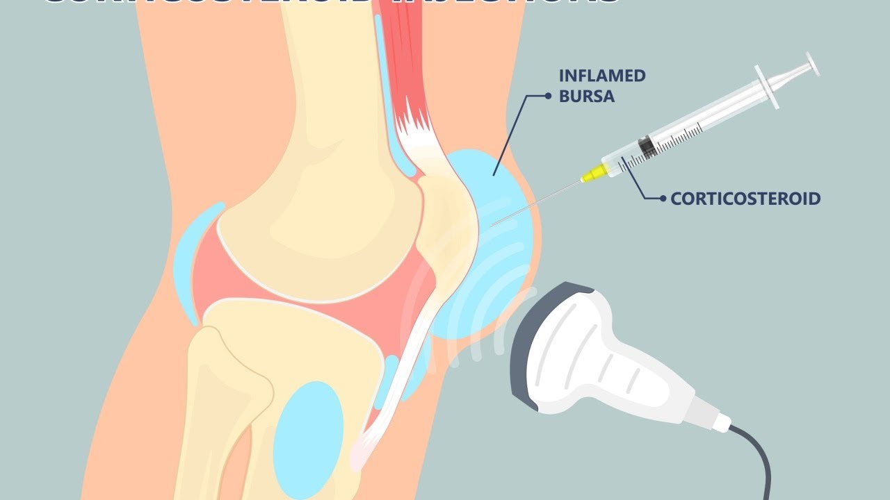 Bursitt = en betent slimpose - forklaring
