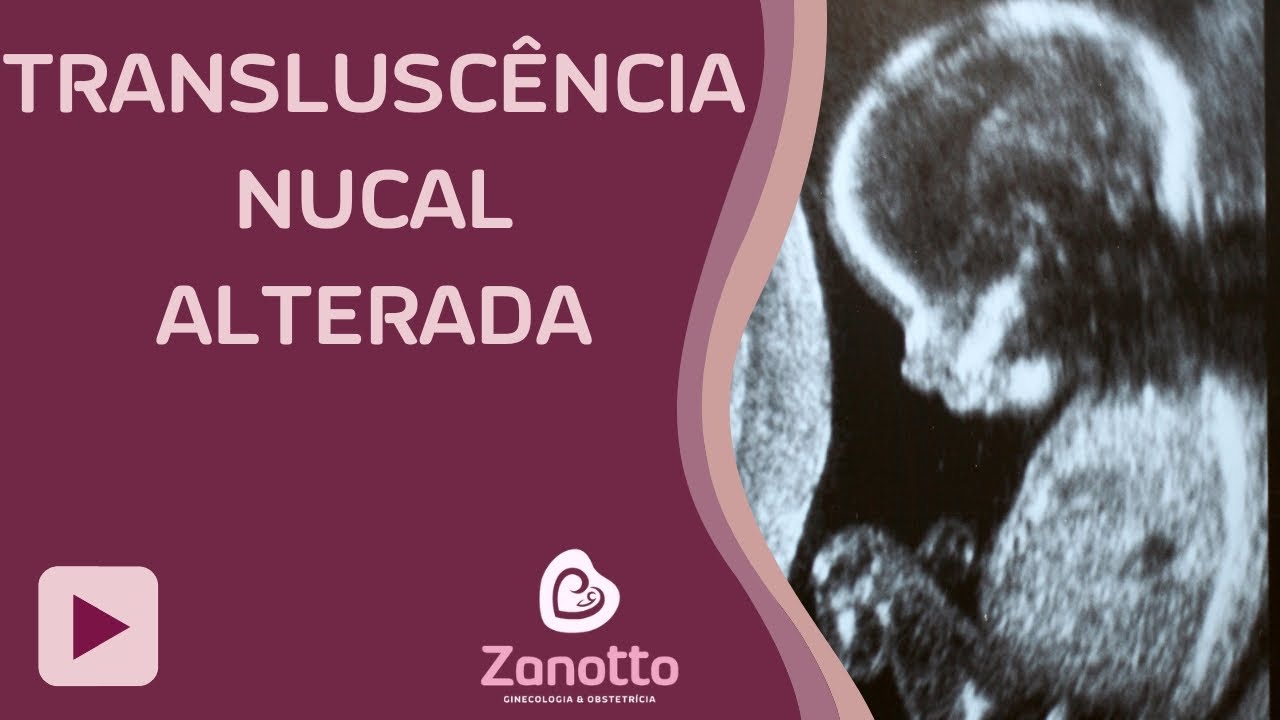 Transluncência Nucal Alterada (TN alterada)