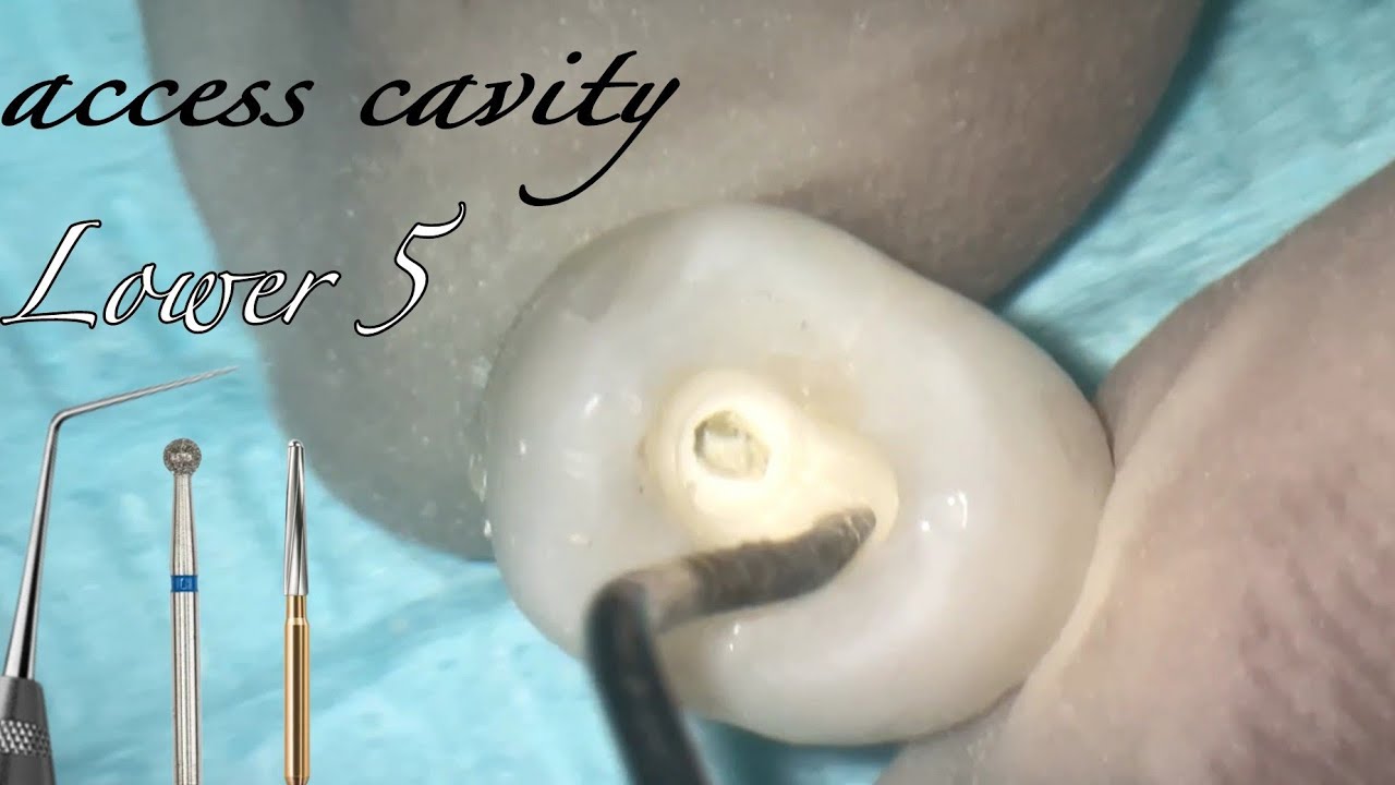 lower premolar access cavity preparation