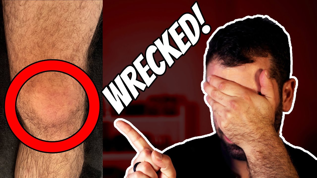 I've Wrecked My Knee! - Advice For Training With Injuries