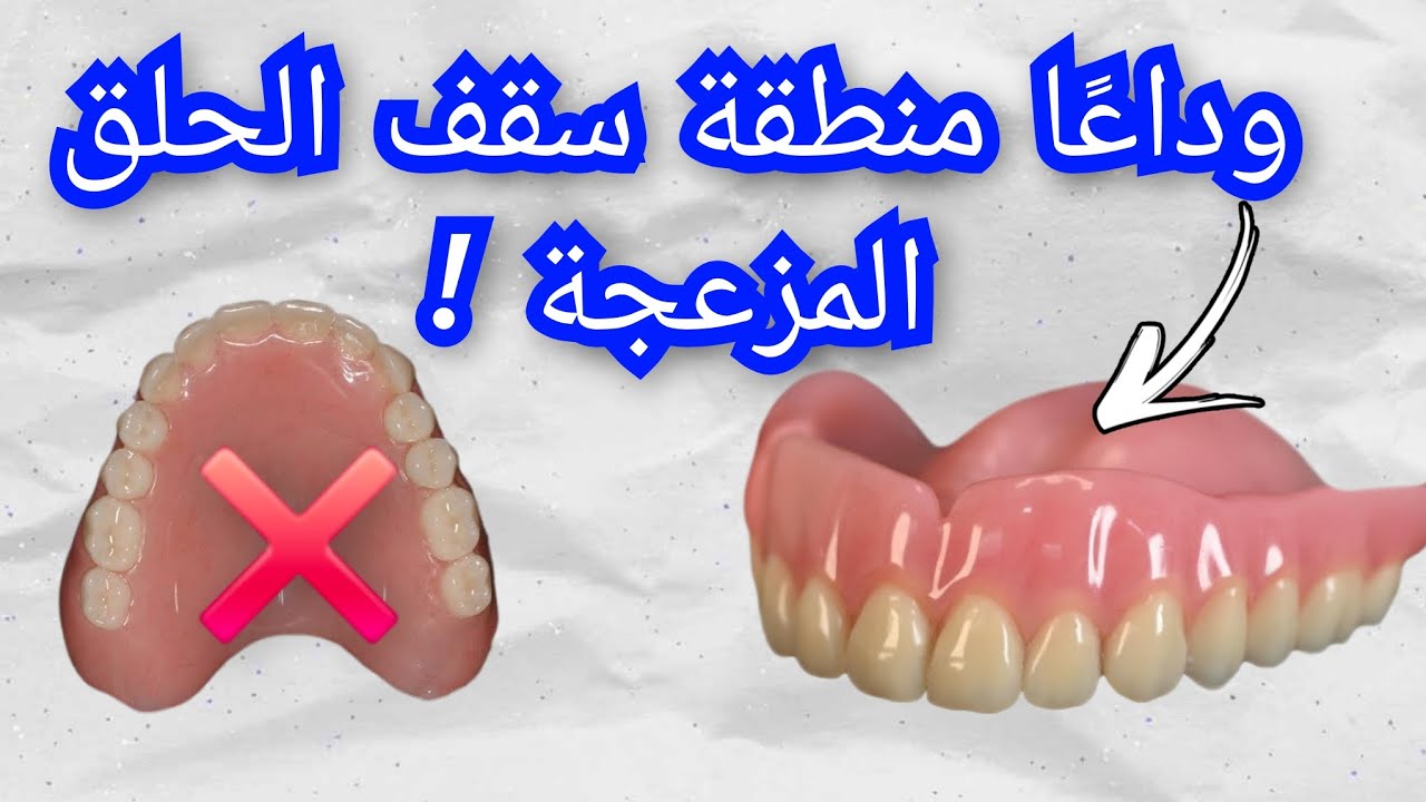 بشرى سارة جدًا. الآن متوفر طقم اسنان علوي عالي الثبات بدون منطقة سقف الحلق المزعجة Prothèse dentaire