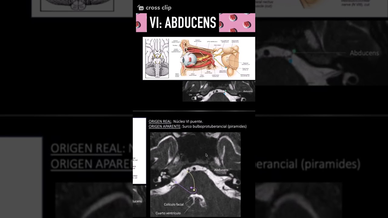 Par craneal 6: Abducens