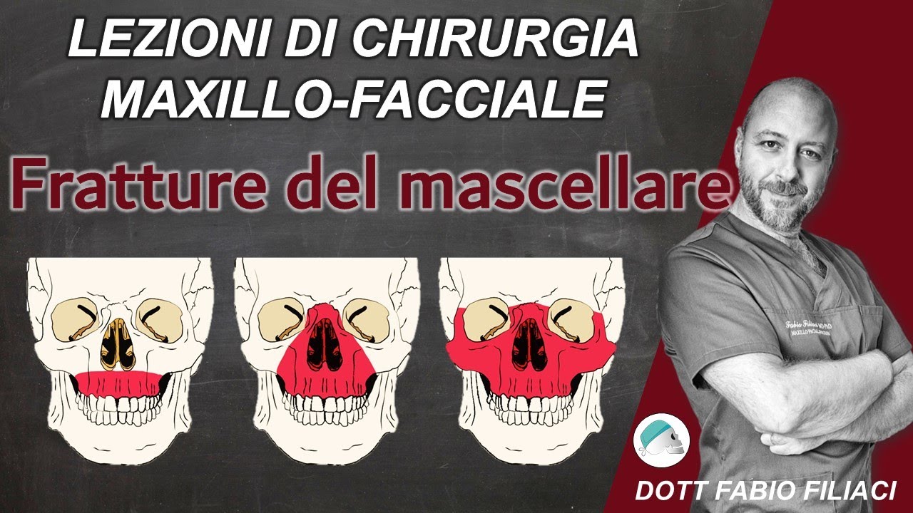 Lezioni di Chirurgia Maxillo Facciale: Le fratture del mascellare superiore di Le Fort