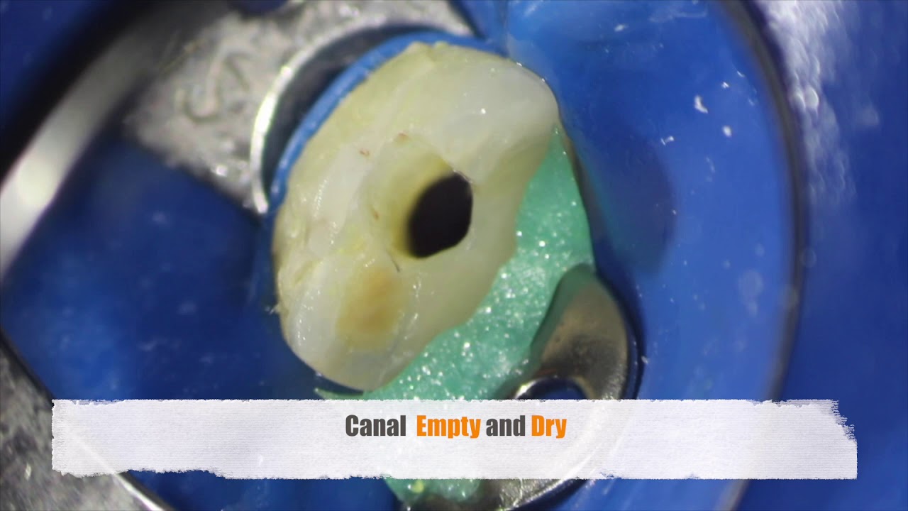 The ENDO MODE / Regenerative endodontics 1