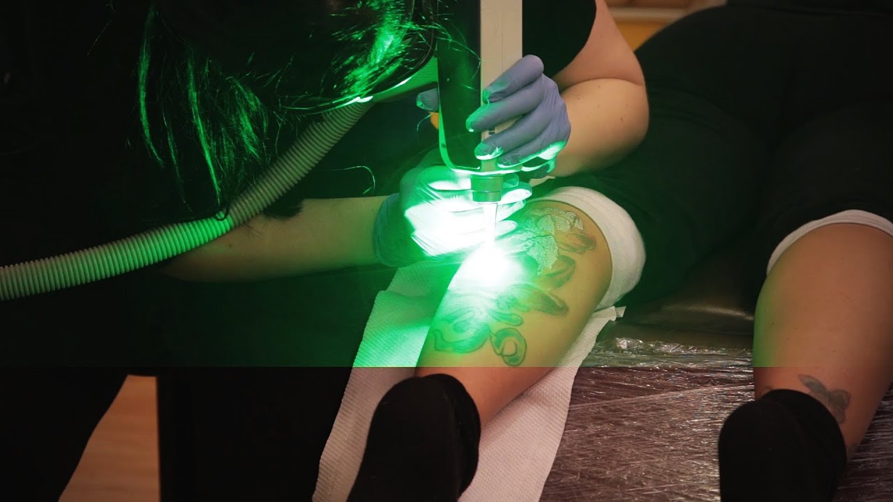 Invictus Tattoo - Lézeres Tetoválás-eltávolítás