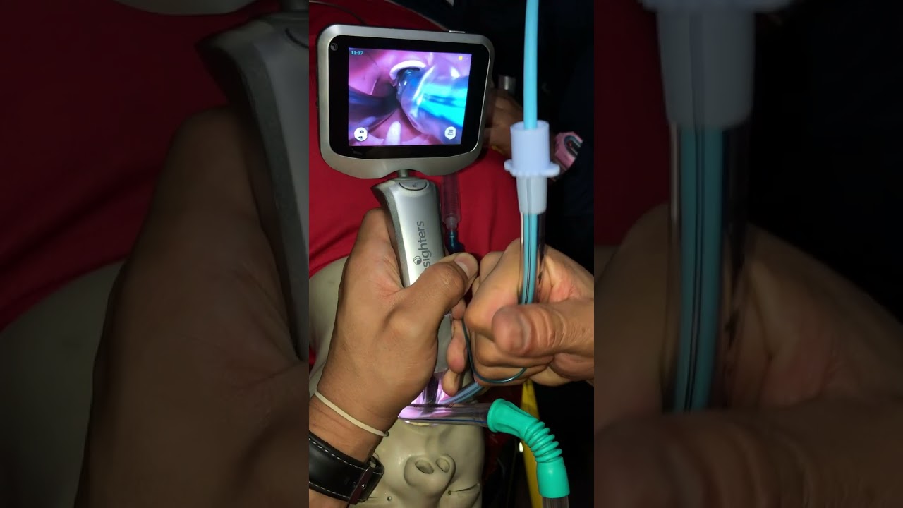 Videolaringoscopia con pala hiperangulada.