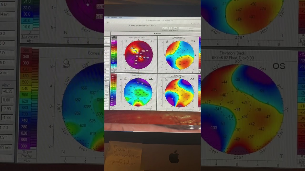 2 step topo-adjusted PRK for high cylinder in a keratoconus cornea transplant: Kanellopoulos, MD