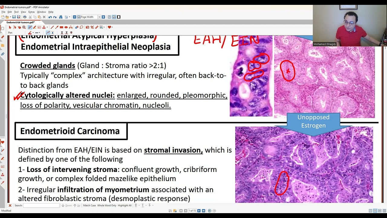 GYN PATHOLOGY: ENDOMETRIAL TUMORS 1