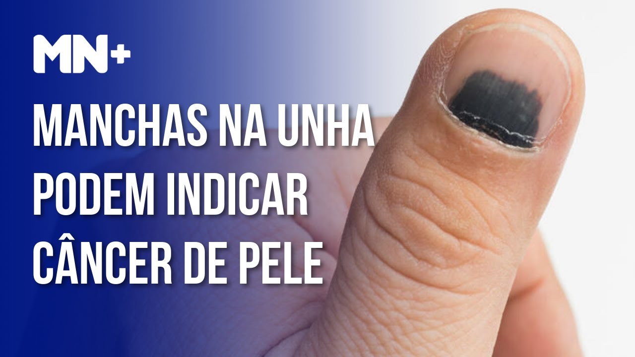 Manchas nas unhas podem alertar para câncer de pele