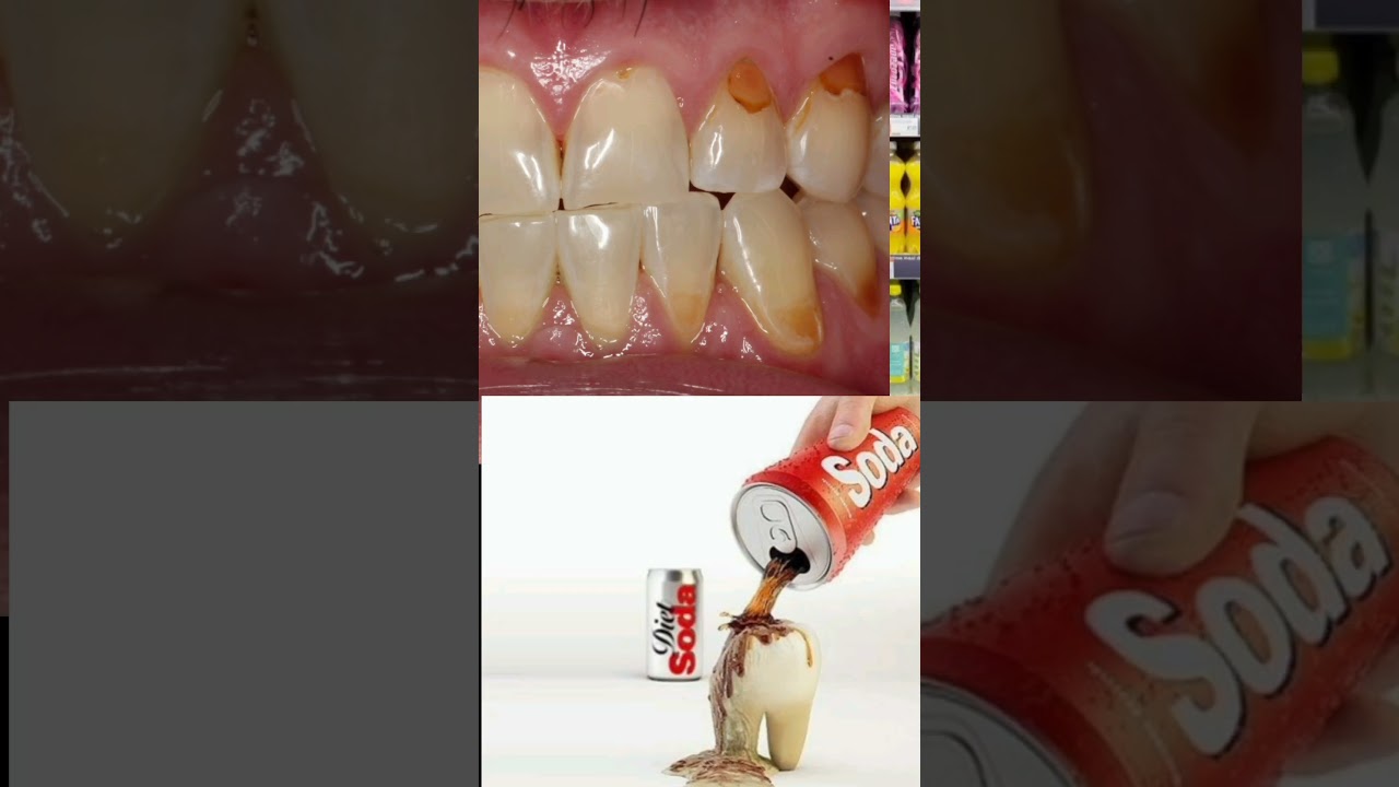Warning: ⚠️ This drink 🥤is Slowly Destroying Your Teeth #trendingvideo  #soda  #youtubeshorts