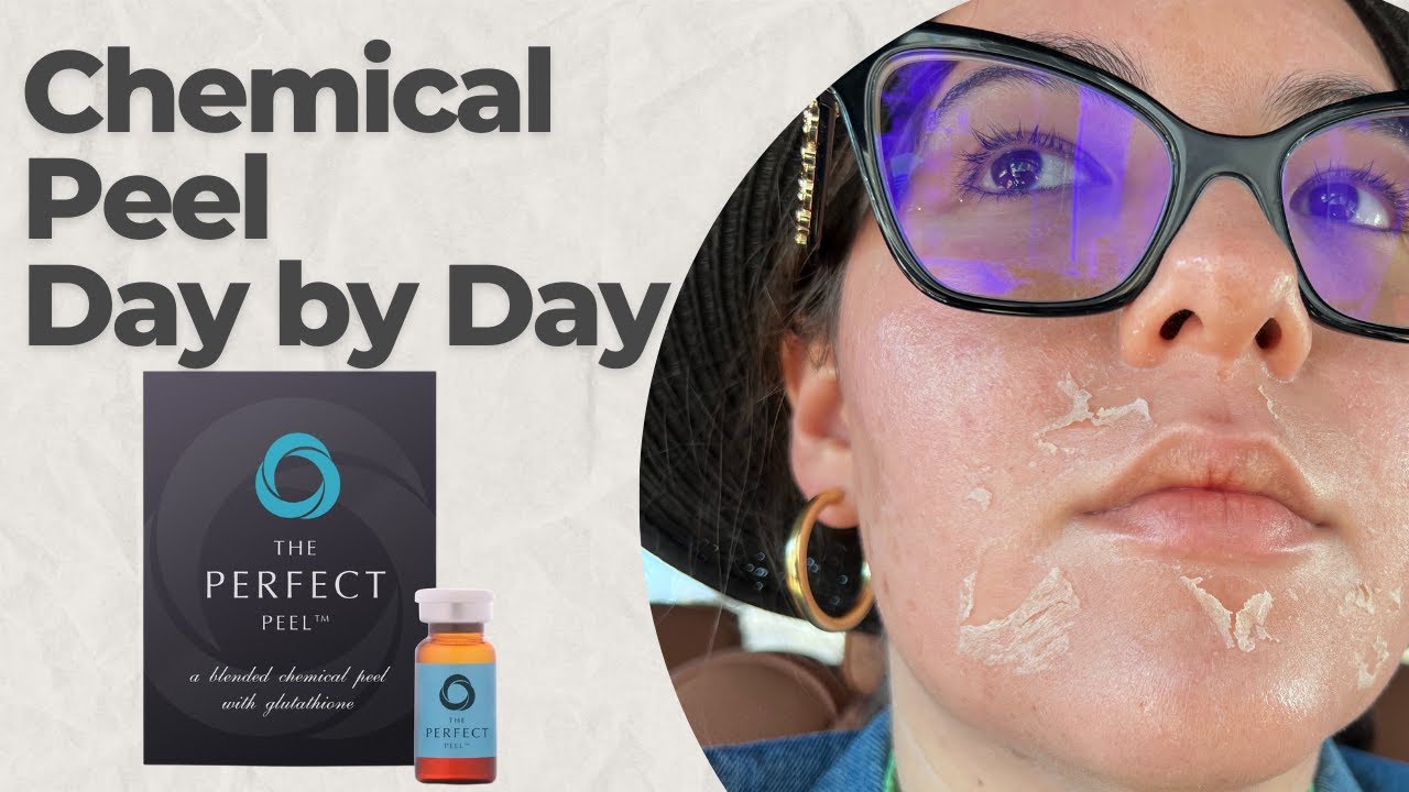 Perfect Derma Chemical Peel FULL PROCESS PEELING Follow Along