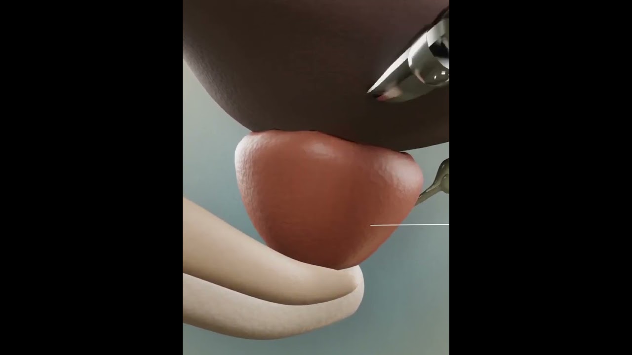 demonstration 3D animation Robot-assisted prostatectomy
