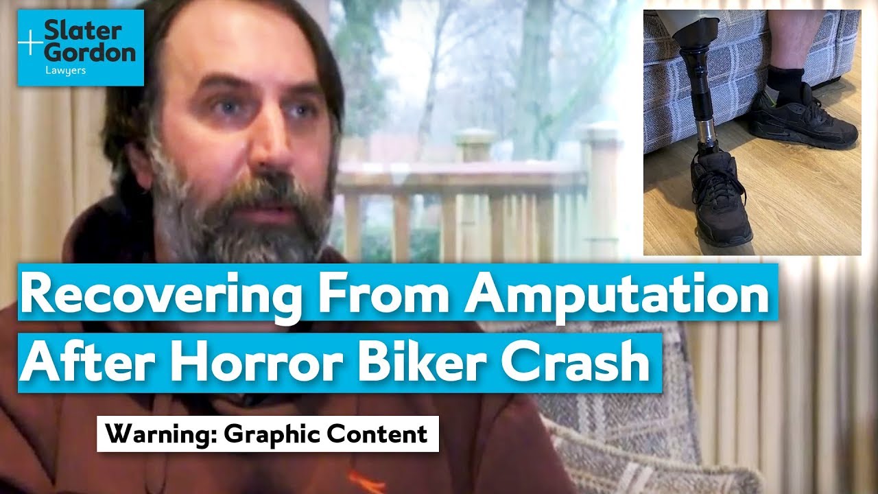 Recovering From Amputation After Horror Biker Crash | Graphic Content
