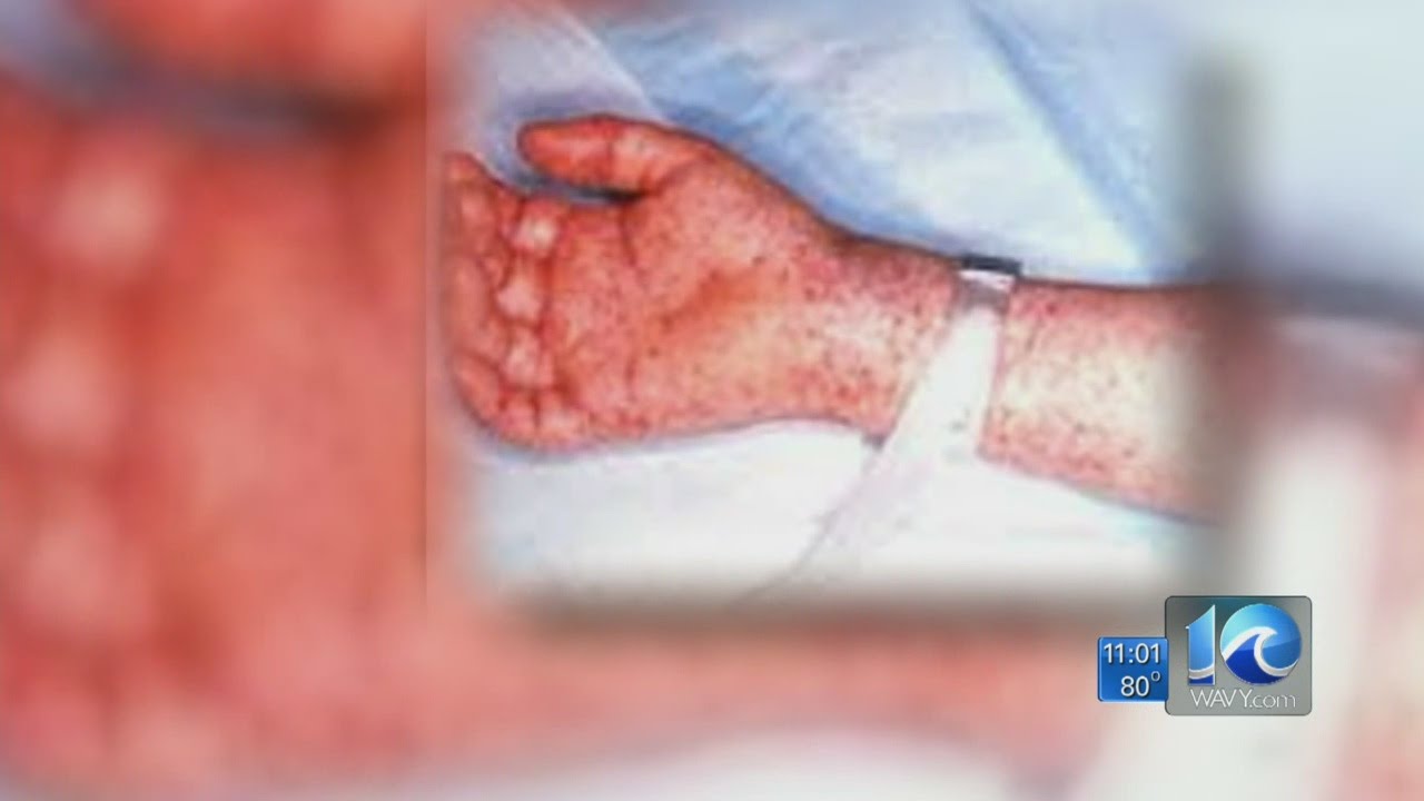 Jason Marks on Rocky Mountain Spotted Fever case