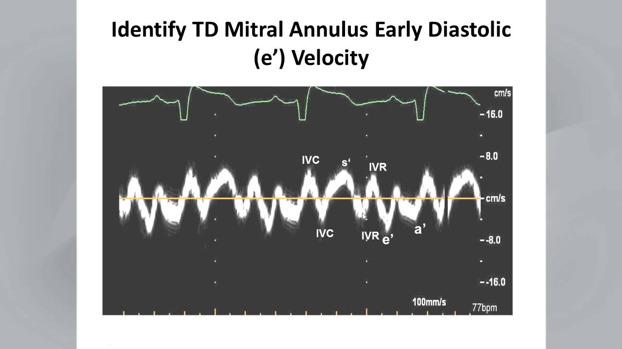 Recommendations for the Evaluation of LV Diastolic Function