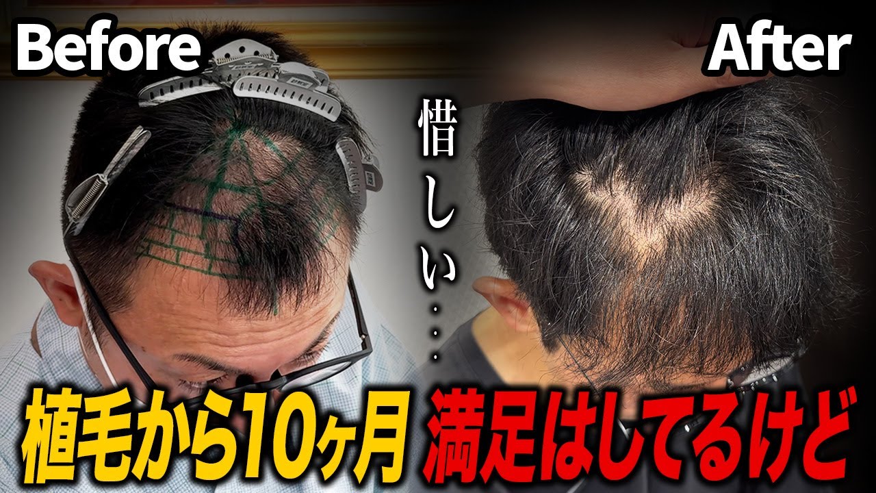 【忖度なし】植毛10ヶ月経過ほぼ満足。でも“ここだけ不満”