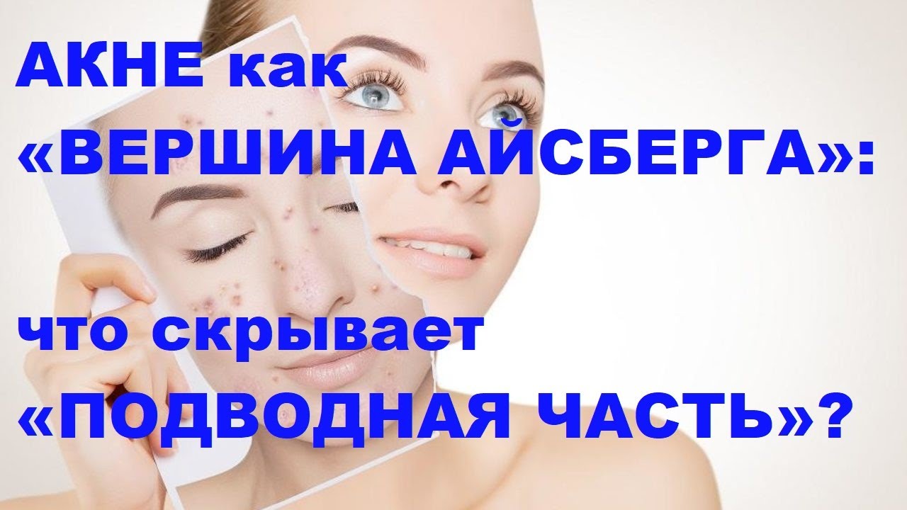 Короткова Н.А. Акне как «вершина айсберга»: что скрывает «подводная часть»?