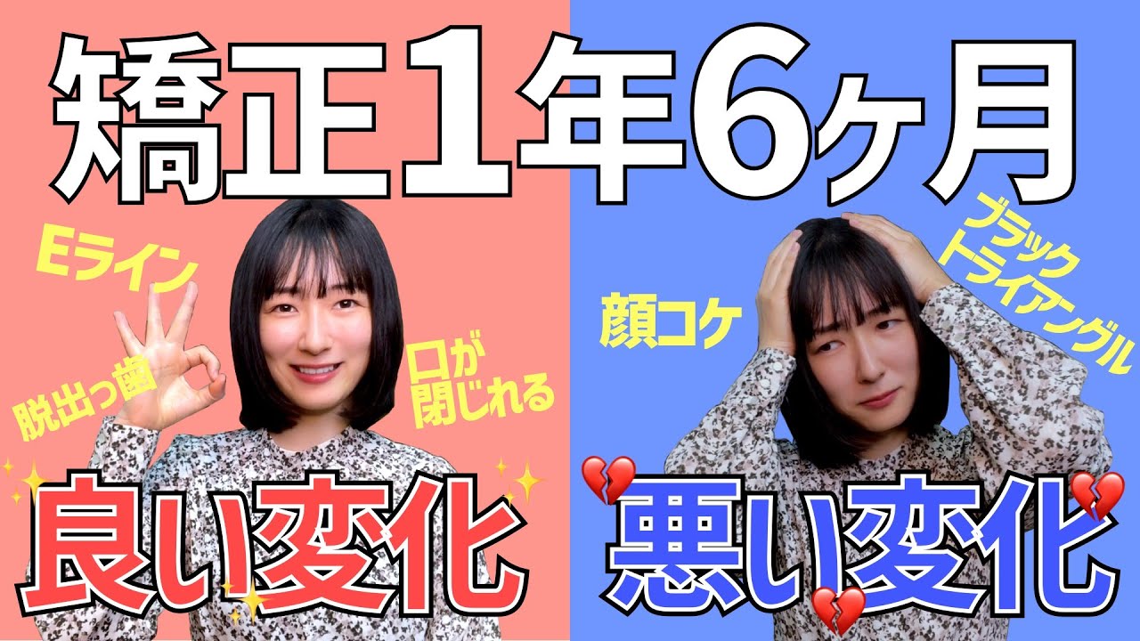 ワイヤー矯正1年6ヶ月の変化を画像たっぷりで振り返りました