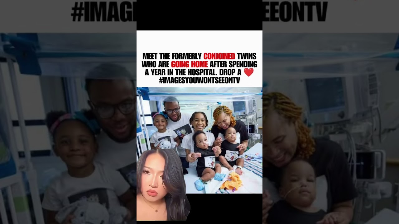 After Spending a Year in the Hospital, These Formerly Conjoined Twins Are Finally Going Home 🥹🏡