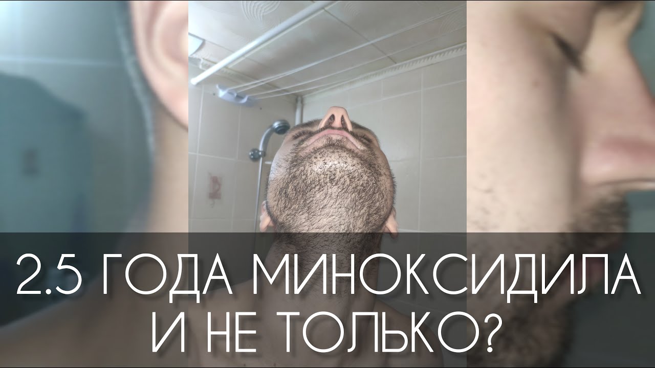 2.5 года пользованием МИНОКСИДИЛА (minoxidil) и не только. Вывод, результат и