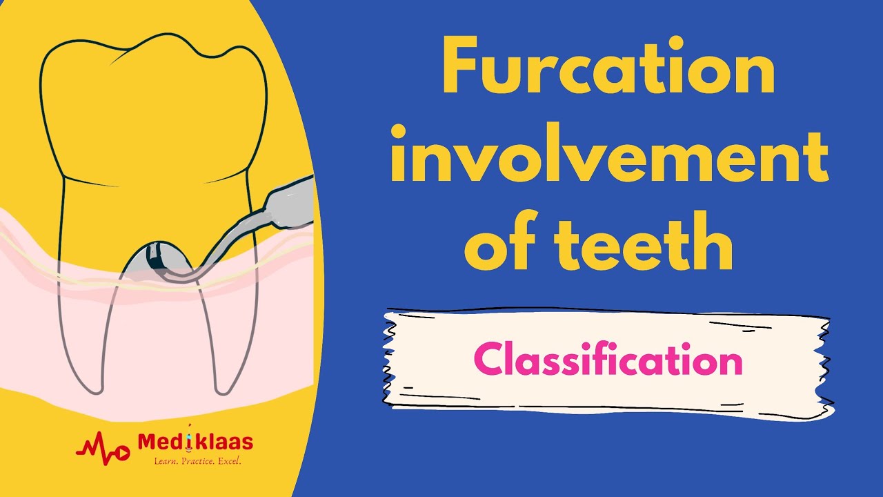 Furcation involvement of teeth - Classification