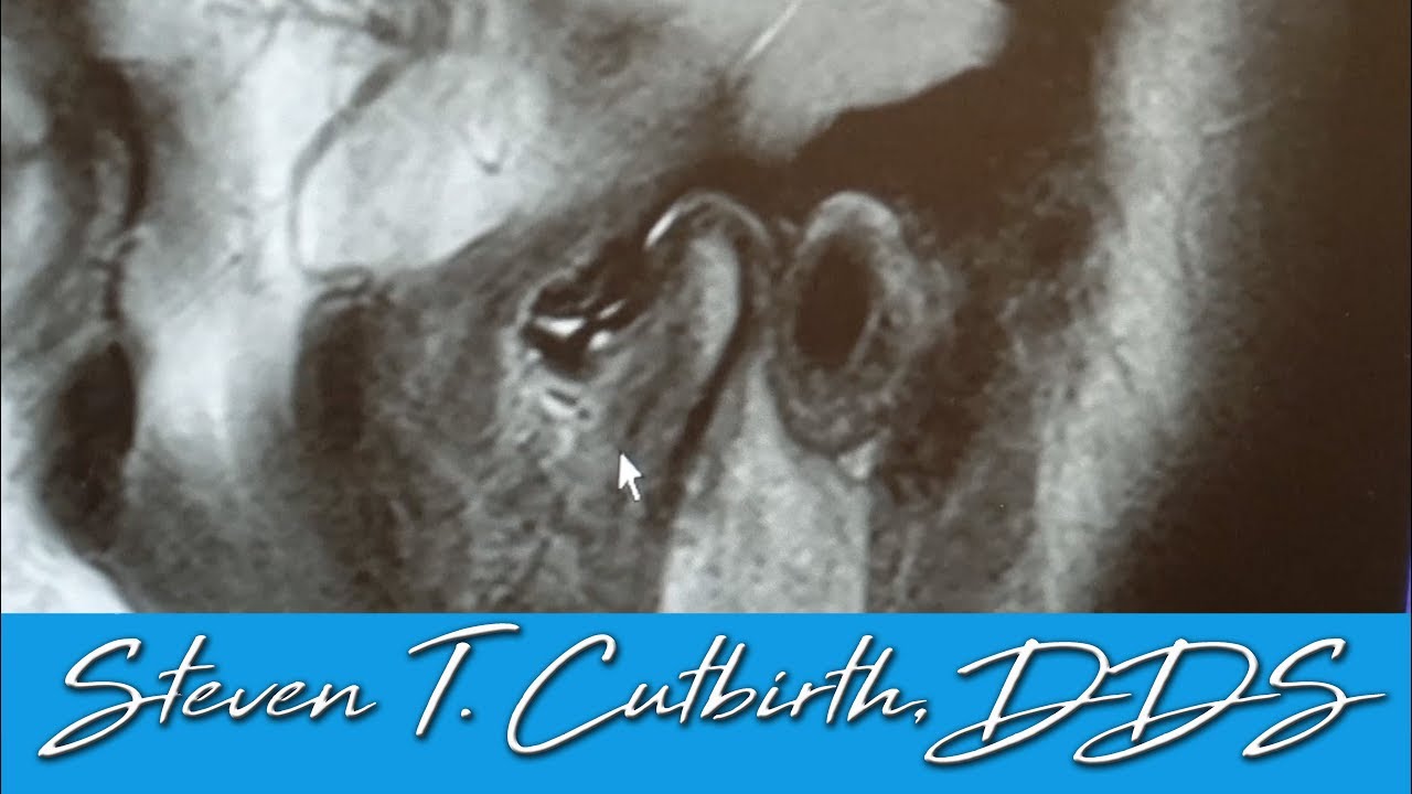 TMJ Treatment Part 1 of 4 - Dental Minute with Steven T. Cutbirth, DDS